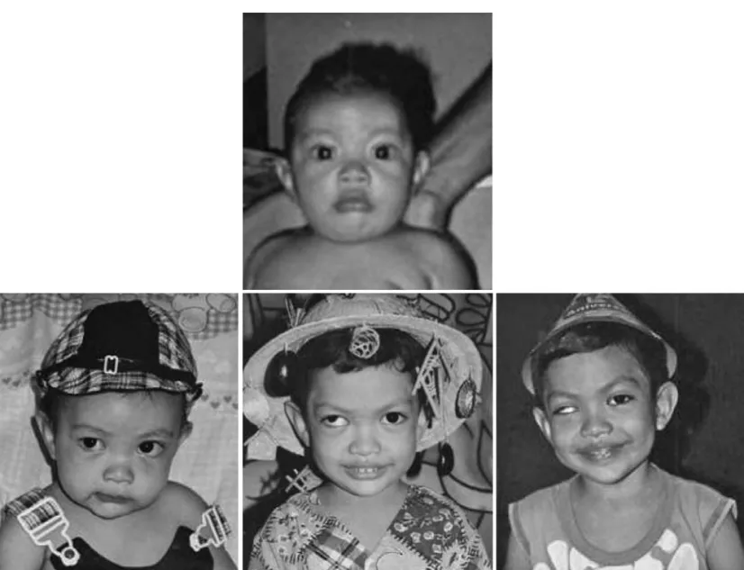 Figure 1. Above - The boy at 8 months of age. Well aligned eyes; Below  - Left: At 2 years of age, his right eye started to elevate; Center: At 3 years of age, a large right hypertropia;