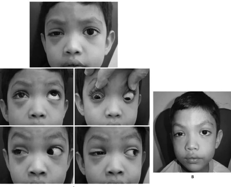 Figure 2. A) One month after the second operation. Good alignment of the eyes in primary position, limitation of elevation and depression (-3) and good lateroversions; a small blepharoptosis