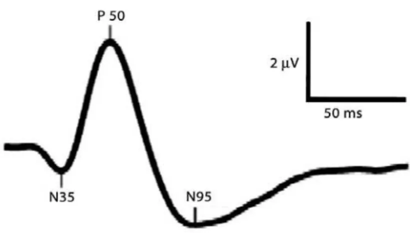 Figure 1. Representative example of a pattern electroretinogram response.