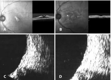 Figure 4. A) Optical coherence tomography (SD-OCT) of an operculated stage III macular  hole
