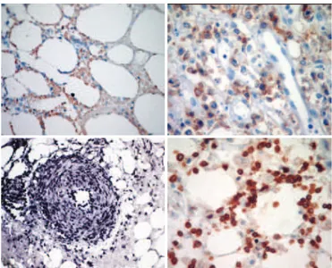 Figure 4. Neoplastic cells showed positivity for CD 3 (cytoplasmic pattern), CD 56  (membrane pattern), Gramzyme B (granular staining) and by the in situ hybridization  for EBV-encoded RNA (EBER), with practically all atypical cells showing nuclear labe   