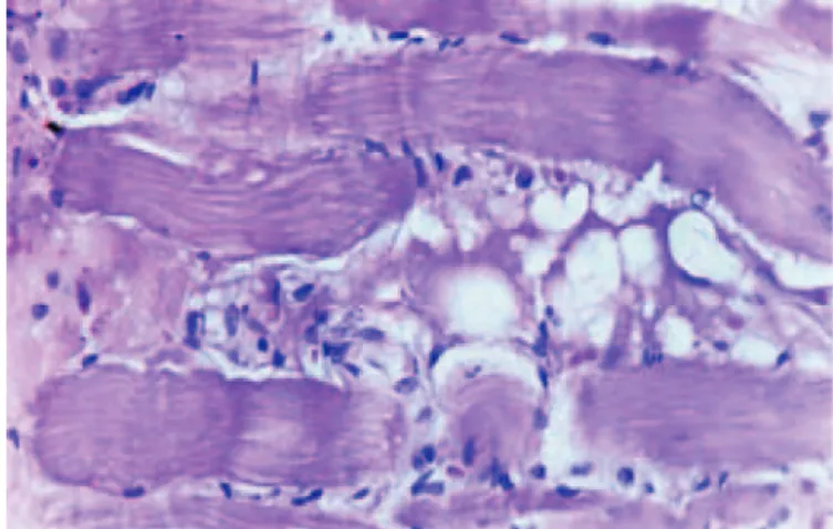 Figure 2. EMG of rabbit 7, twenty-three days after the injection of 2U botulinum  toxin type A.