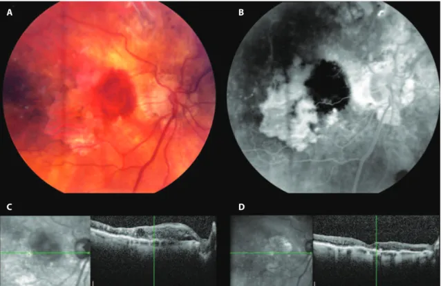 Figure 1. Fundus photographs of study eye 1 with subretinal hemorrhage resulting from occult choroidal neovascularization at the edge  of pre-existing geographic atrophy (A and B), and optical coherence tomography of the central macula before (C) and two m