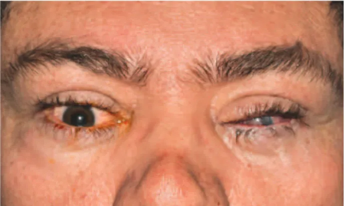 Figure 1. Left globe subluxation. The left cornea is covered by a white ibrinous  membrane