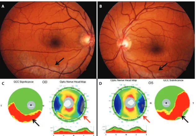 Figure 1. Fundus pictures showing patches of retinochoroidal atrophy (arrows) and pigmentation along the inferior-temporal retinal veins in both  eyes (A, right eye; B, left eye)