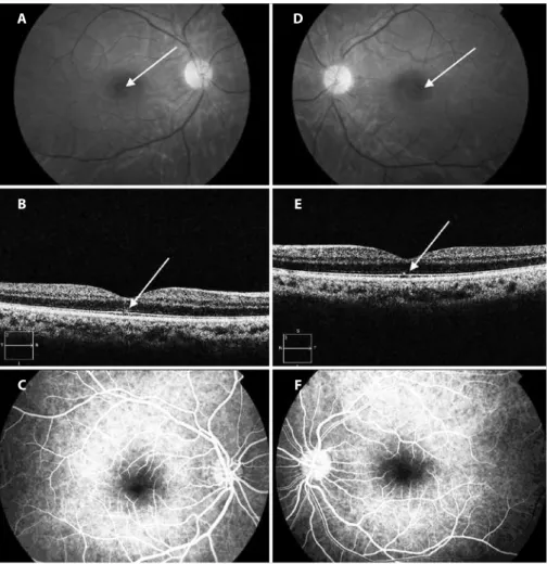 Figure 1. Images of the fundus collected during the irst visit of the patient. A, B and C) Belong to the right eye; D, E  and F) Belong to the left eye