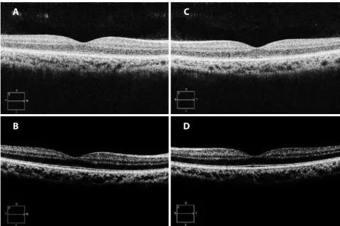 Figure 3. Microperimetry of right (A) and left (B) eye performed ten months after retinal  injury