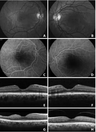 Figure 2. A 23-year-old patient with sickle cell anemia (HbA1 - 0%, HbA2 - 2.7%, Fetal  Hb - 25.4% and HbS - 71.9%) with macular atrophy with 20/20 visual acuity in both  eyes