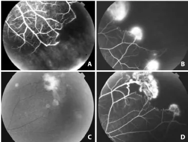 Figure 6. Complications of proliferative sickle retinopathy in a patient of SC genotype