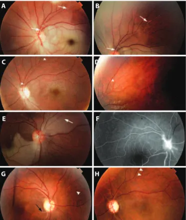 Figure 1. Fundus photograph of the left eye (A and B) and the right eye (E) at presentation; 