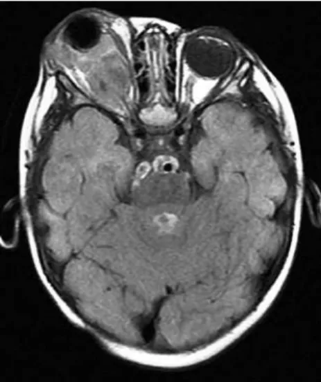 Figure 2. A) General view of the optic nerve, partially showing the lamina cribrosa (arrow)  without tumor cell invasion