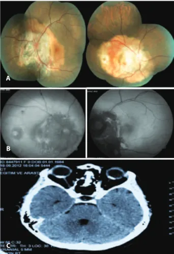 Figure 1. Fundus of RE and LE tumor vessels known as spiders are indicated with arrows