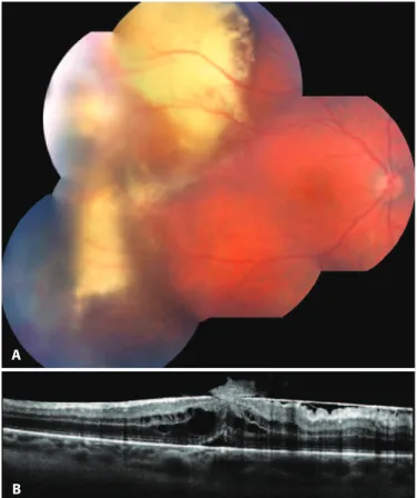 Figure 3. A) Tumor in the temporal superior periphery with massive exsudation. B)  Optic coherence tomography of the same case showing cystoid macular edema and  epiretinal membrane