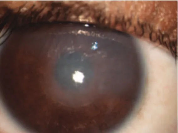 Figure 1. Right eye with stromal edema and Descemet folds over keratic precipitates.