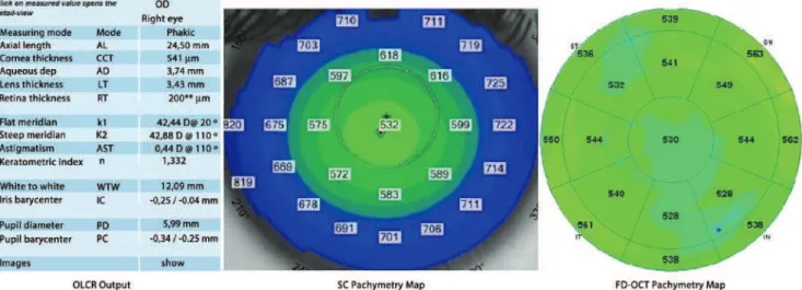 Figure 1. Optical low-coherence relectometry output, Scheimplug camera and Fourier domain optical coherence tomography pachymetry maps demonstrating central  corneal thickness measurements obtained from a subject.