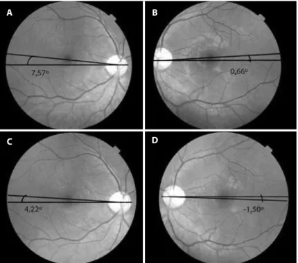 Figure 2. A) Right eye: preoperative torsion angle. B) Left eye: preoperative torsion angle