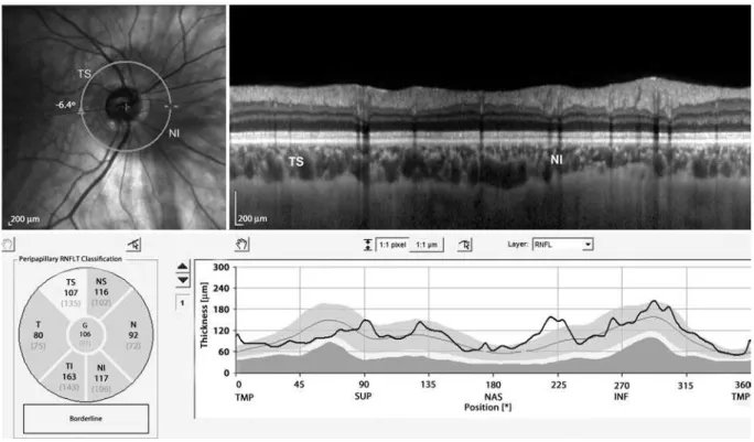 Figure 1. Inferior nasal crescent and superotemporal disc rim elevation with loss of superior retinal nevre iber layer thickness veriied in OCT