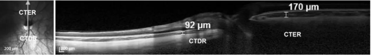 Table 1). The RNFL thickness of the nasal sector was signiicantly higher  in the tilted disc group (p=0.013); however, the global RNFL was  signi-icantly lower in the tilted disc group (p=0.005).