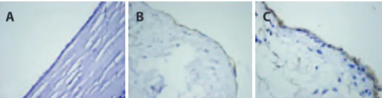Figure 2. Immunohistochemical staining of the endothelial cells for caspase 8. Negative  (A), weak (B), and moderate (C) (caspase-8 × 400).