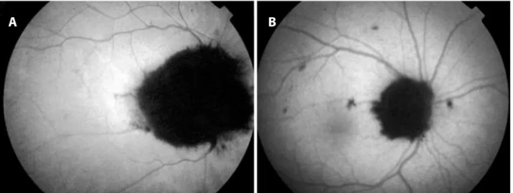 Figure 3. Outstanding hypoautoluorescence at the tumor area followed by isoautoluorescence at the remaining re   tina  (A and B).