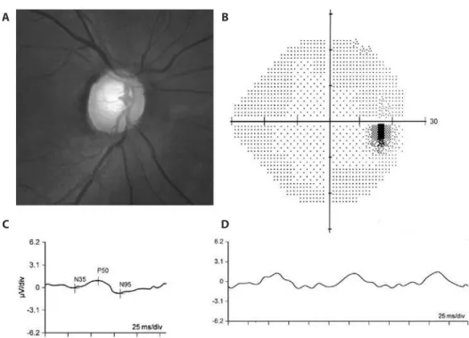Figure 2. Representative example of an eye with pre-perimetric glaucoma and reduced pattern electroretinogram  (PERG) responses