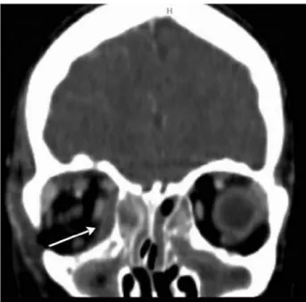 Figure 1. Coronal CT scan of the right medial SPA in a 15 years old patient. 