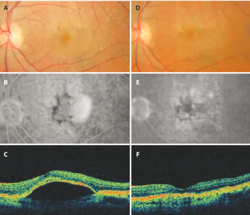 Figure 2. Case 1. Initial color retinography (A). Intermediate phase of luorescein angiography showing dye pooling and  foci of hyperplasia of the retinal pigment epithelium (B)