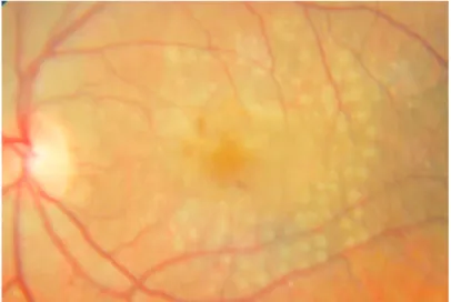 Figure 4. Case 2. Color retinogram performed before treatment showing PED with mainly atrophic difuse changes in the  pigment epithelium (A)