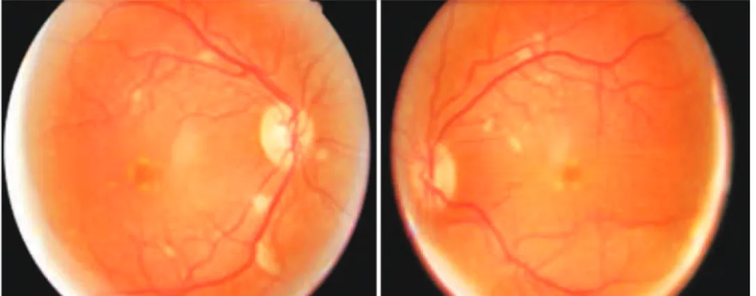 Figure 1. Fundus exam of the patient upon arrival in the emergency room following the use of interferon for three months