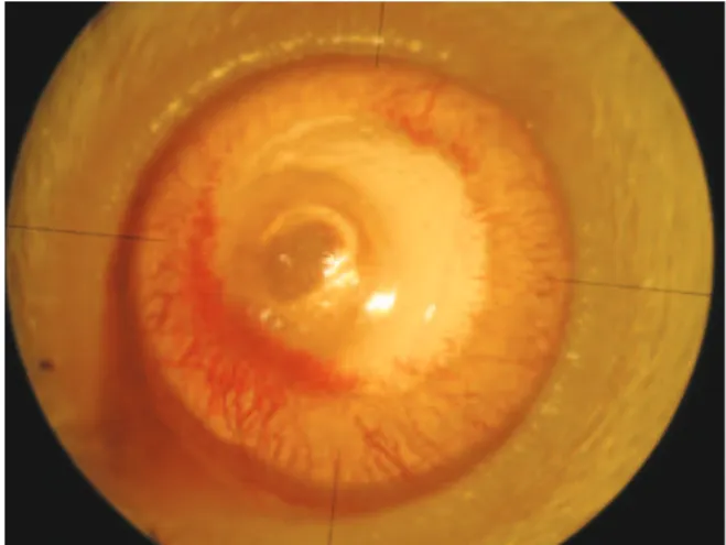 Figure 3. Image of an eye with corneal neovascularization after eight days of treatment