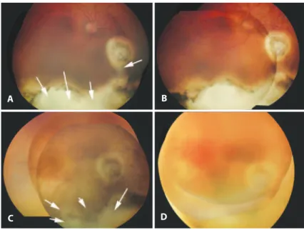 Figure 1. RetCam® photographs of the patient’s right eye at various time points. A) First exam at  presentation
