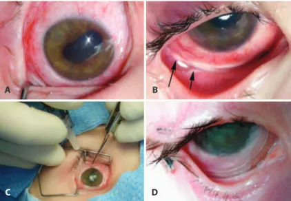 Figure 2. The complications of extensive and intensive treatment for intraocular retinoblastoma