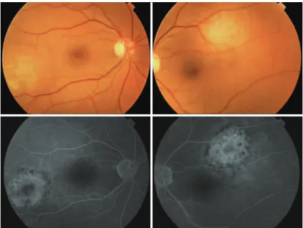 Figure 1. Fundus photography and luorescein angiography (FA). Bilateral temporal hypopigmented  lesions are observed