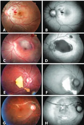 table 2. Correlation between the indings of fundus examination and  FAF imaging