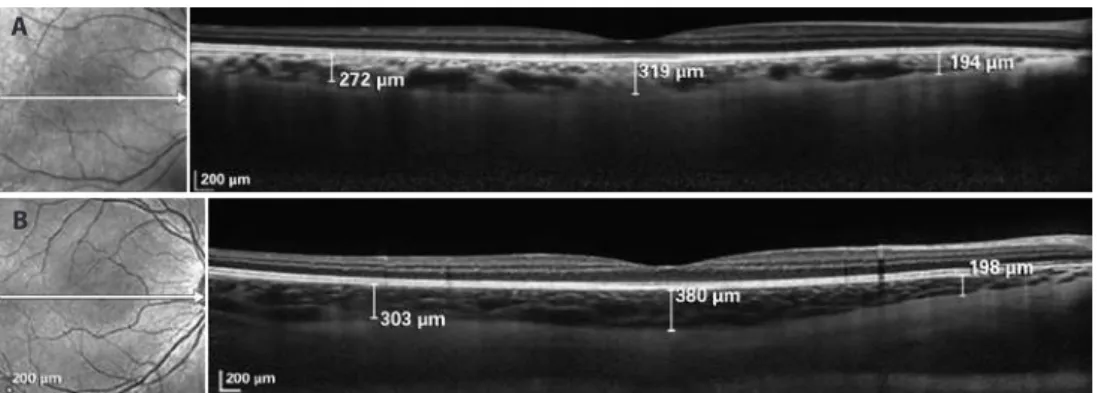 Figure 1. A) Optical coherence tomography image from the control group demonstrating enhanced depth imaging on Spectralis  (Heidelberg Engineering)