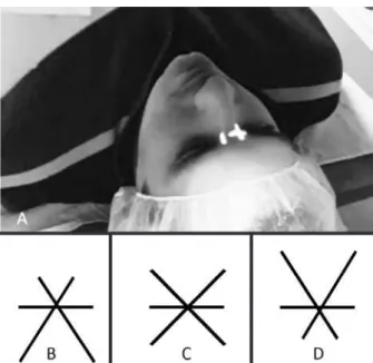 Figure 1. Adjustment of head positioning using the centration lights of the  excimer laser on the glabella