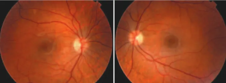 Figure 2. Color retinography of both eyes of patient 1 showing no retinal lesions at one  year follow-up.