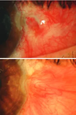 Figure 2. The sclera dellen on day 3 (top) and on day 7 (bottom) from its onset. Figure 3
