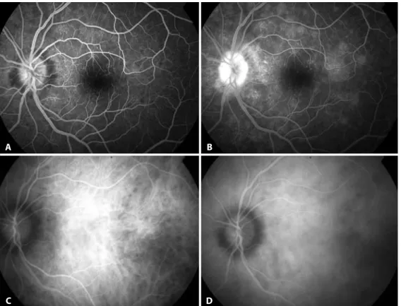 Figure 2. Multiple evanescent white dot syndrome lesions. A) Fluorescein angiography demonstrating early hyperluorescent lesions