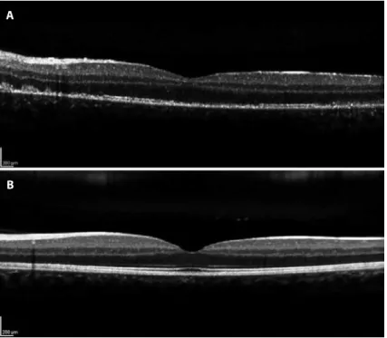 Figure 3. A) Spectral Domain Optical Coherence Tomography (SD-OCT) demonstrating mild attenua- attenua-tion of the external limiting membrane, disrupattenua-tion of the macular photoreceptor inner segment-outer  segment (IS-OS) junction, and increased RPE 