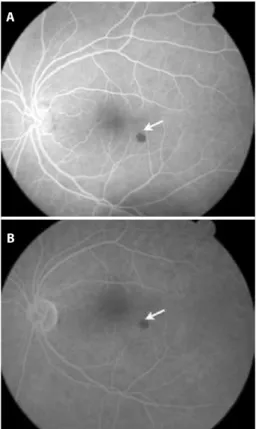 Figure 2. Optical coherence tomography. Slight elevation of the retina is observed at the  location of the lesion, which is protruding into the vitreous cavity and shows increased  optical relectivity on its inner surface, with deep optical shadowing of th