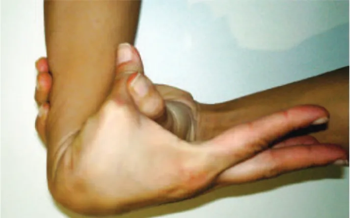 Figure 1. Apposition of the thumb to the lexor aspect of the forearm. Figure 2. Hyperextension of the elbow beyond 90 degrees (neutral).