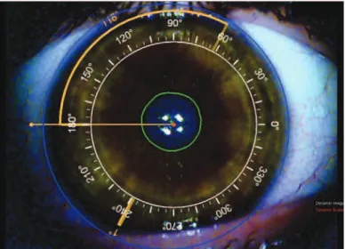 Figure 1. Image from iTrace to guide intraocular (IOL) lens alignment in a patient’s right  eye