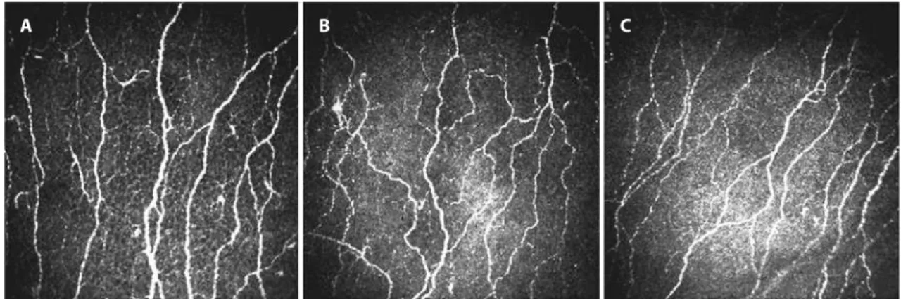 Figure 1.  In vivo  confocal microscopic images of the sub-basal nerve plexus. (A) Representative image from a healthy control subject with normal  corneal nerve ibers