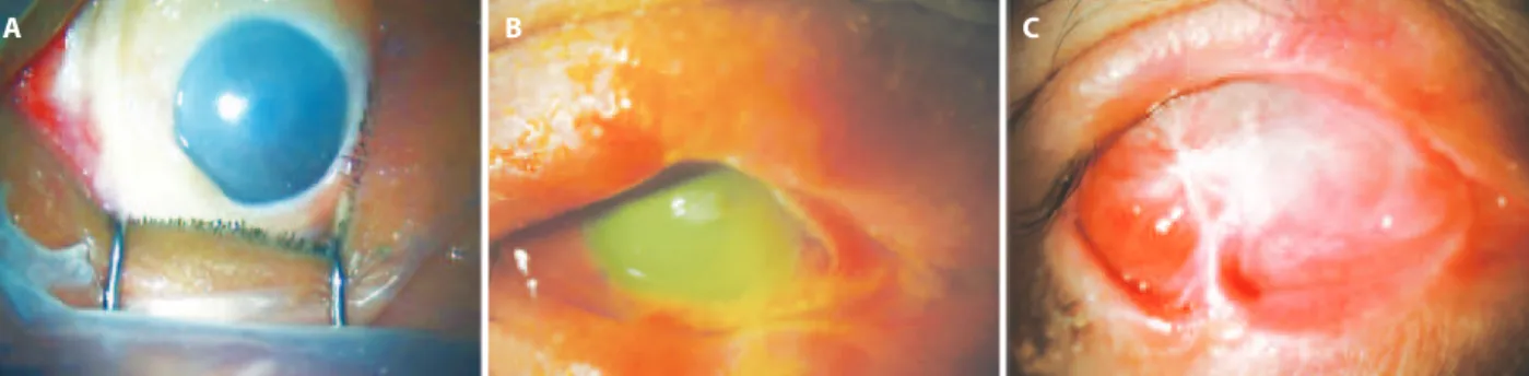 Figure 1. A) Biomicroscopic examination showed burns of the upper and lower eyelids and eyelashes, total corneal loss of transperancy, 360° limbal ischemia, and  difuse burns in the bulbar conjunctiva approximately two and a half hours following an inciden