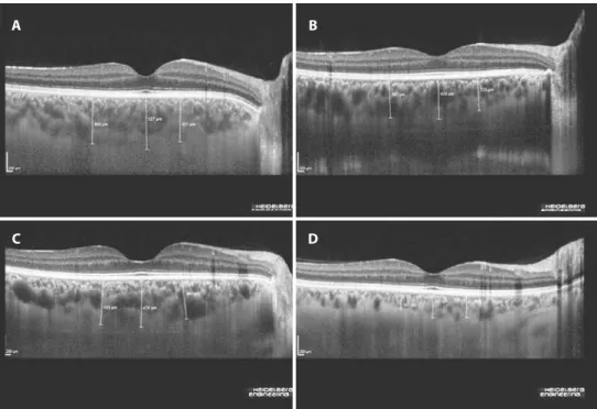 Figure 1. Enhanced depth imaging–spectral domain optical coherence tomography images obtained from patients with inlam- inlam-matory bowel disease