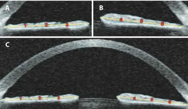 Figure 1. Anterior segment optical coherence tomography (AS-OCT) images with iris  area and iris thickness demarcation