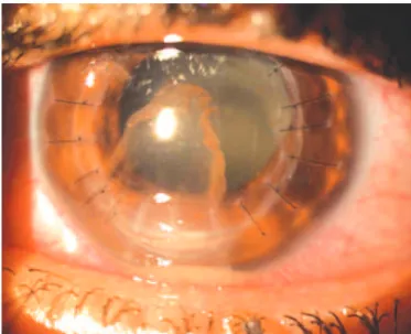 Figure 1. Traumatic inferior graft dehiscence with corneal iniltrate and hypopyon.