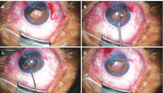 Figure 1. A) Inferiorly dislocated intraocular lens; B) Paracentesis opposite to entrance site; C) Needle passed inferiorly to the  haptic; and D) Needle removal following paracentesis.
