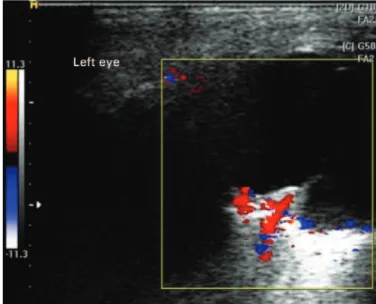 Figure 2. Left eye ultrasonography (10 MHz), showing a solid elevated medium-high  relective lesion, which extends from the optic nerve to the posterior pole